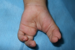 Cleft Hand