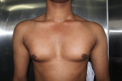 Gynaecomastia