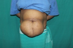 Incisional Hernia repair