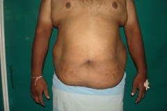 Male Abdominoplasty