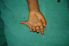 Polydactyly